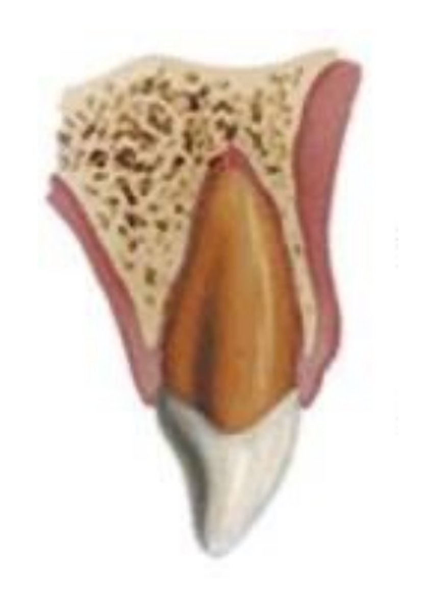 <p>which type of traumatic luxation injury:</p><p>- Tooth is tender to touch and mobile,</p><p>but not displaced</p><p>- Hemorrhage from gingival sulcus</p><p>possible</p><p>Diagnosis:</p><p>- 2+ PA radiographs</p><p>- No radiographic abnormalities</p><p>Treatment:</p><p>- Flexible splint is optional</p><p>- splint for 2 weeks using a flexible splint up to .4mm</p>