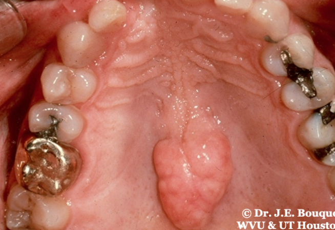 <p>bony growth on the hard palate </p>