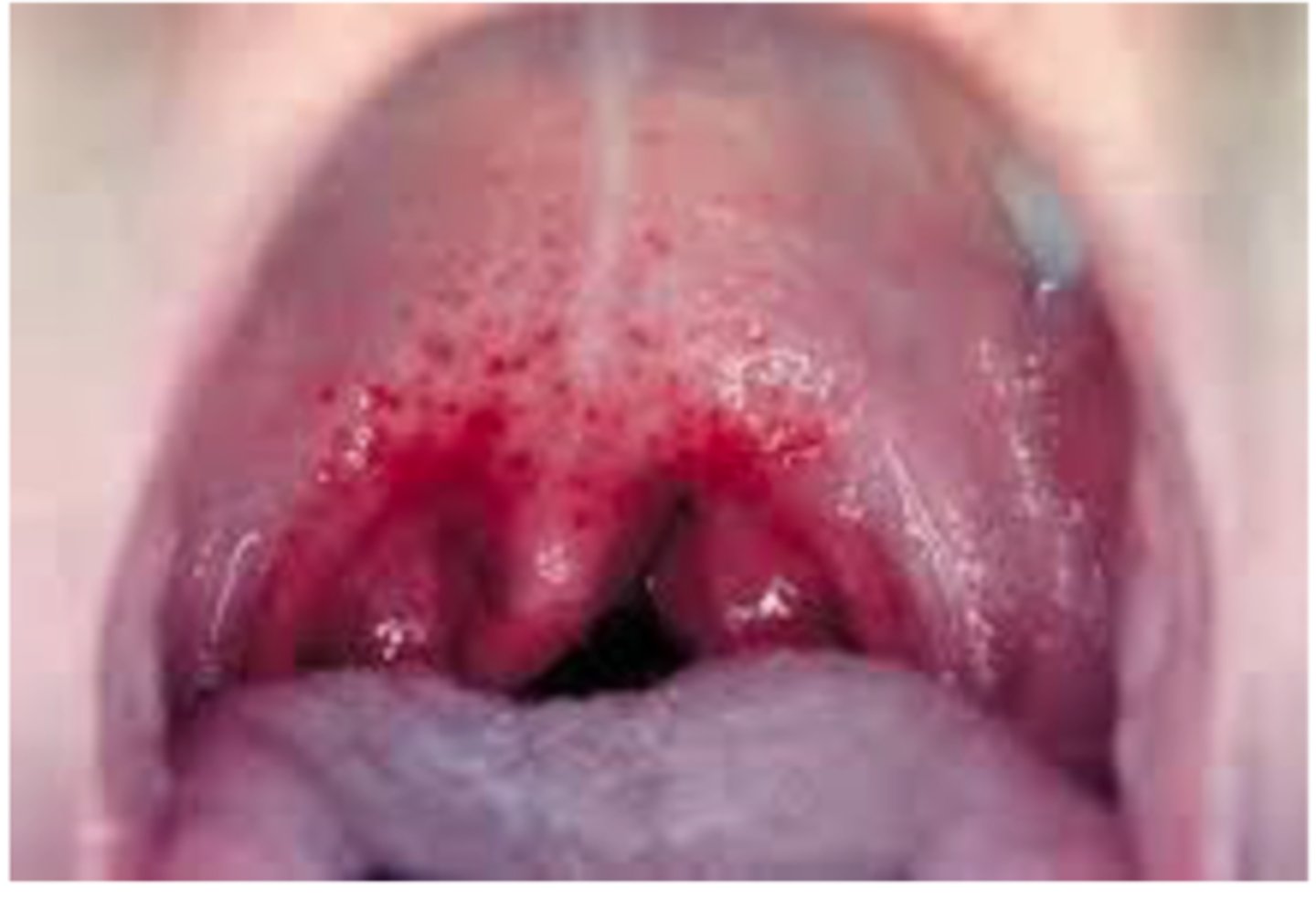 <p>-causes infectious mononucleosis and Burkitts lymphoma, which is a malignancy of the lymph tissue</p><p>-transmitted by kissing</p>