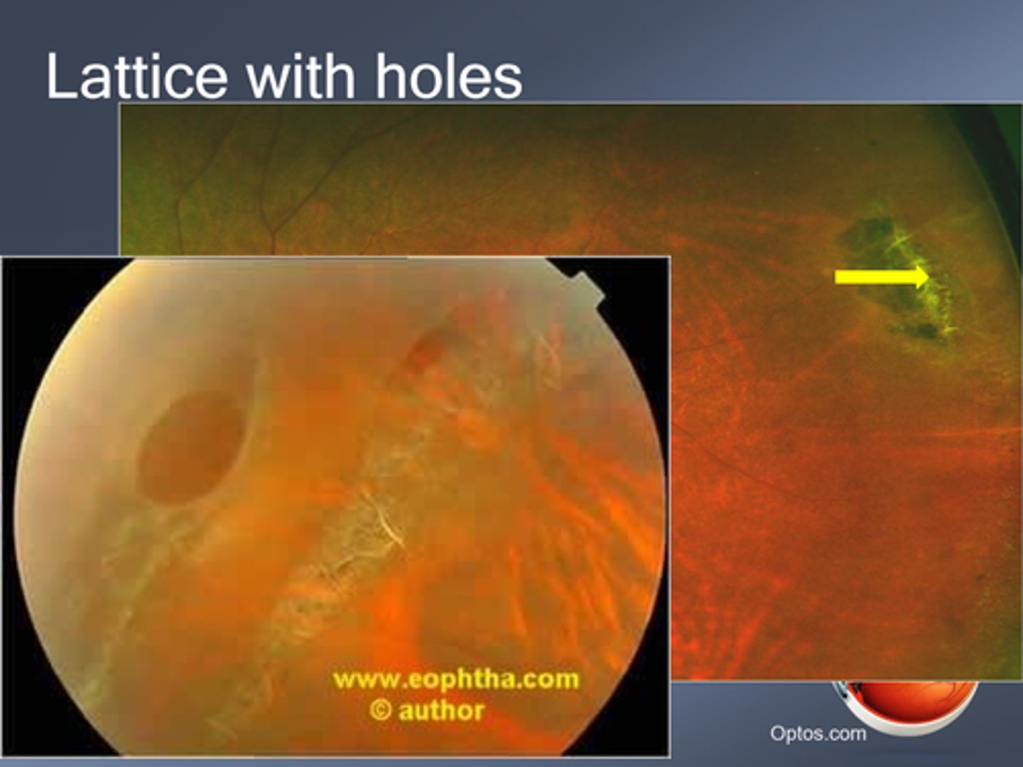 <p>monitor for retinal tears, RD</p><p>prophylactic laser</p>