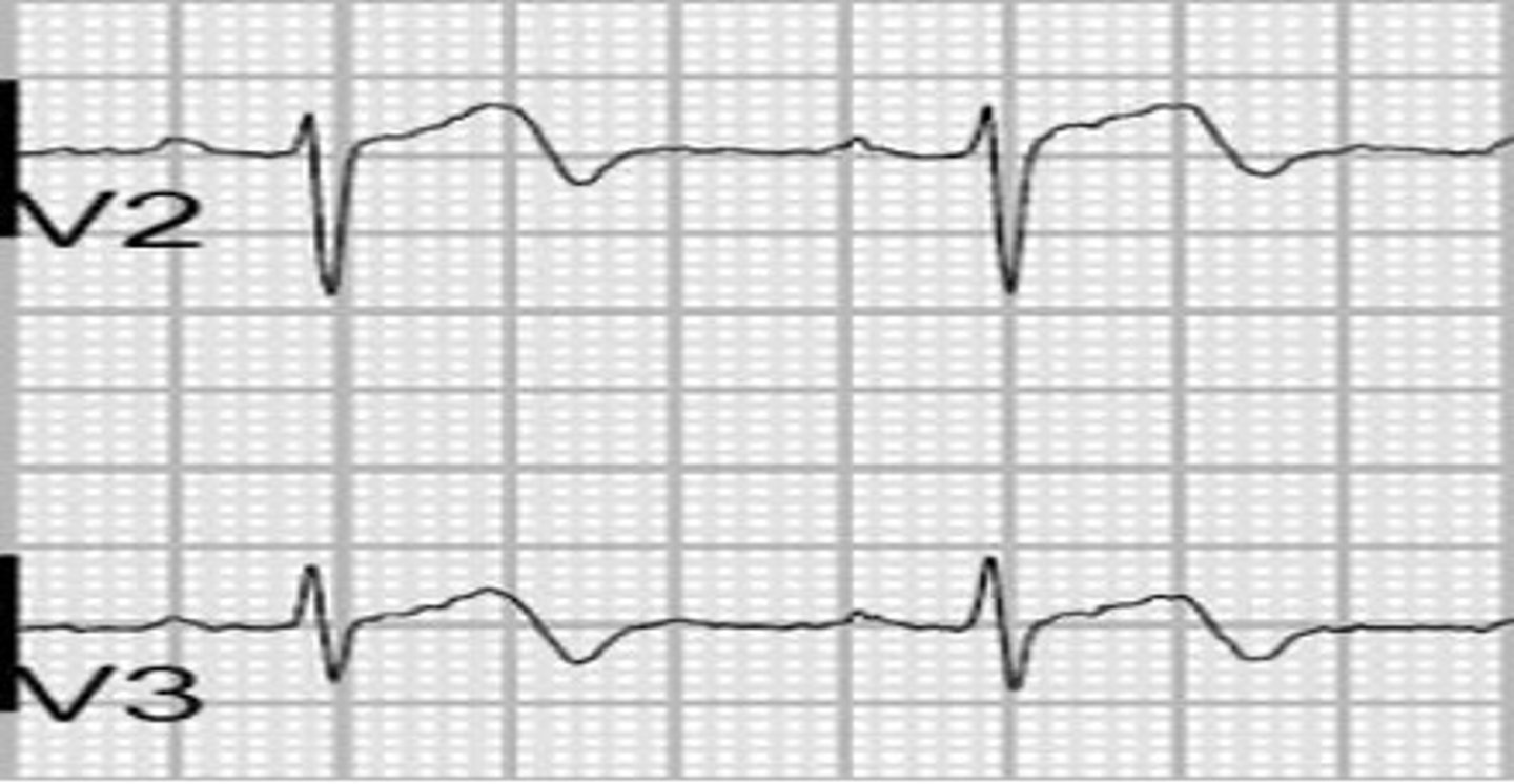<p>biphasic T waves in leads V2 and V3 (25%)</p>