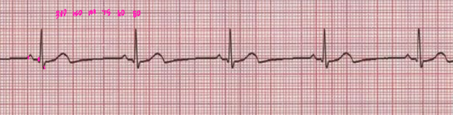 <p><strong>Sinus Bradycardia</strong></p><p>-Rhythm, intervals, and morphology are _______</p><p>-The heart rate is _____ than 60 bpm</p>