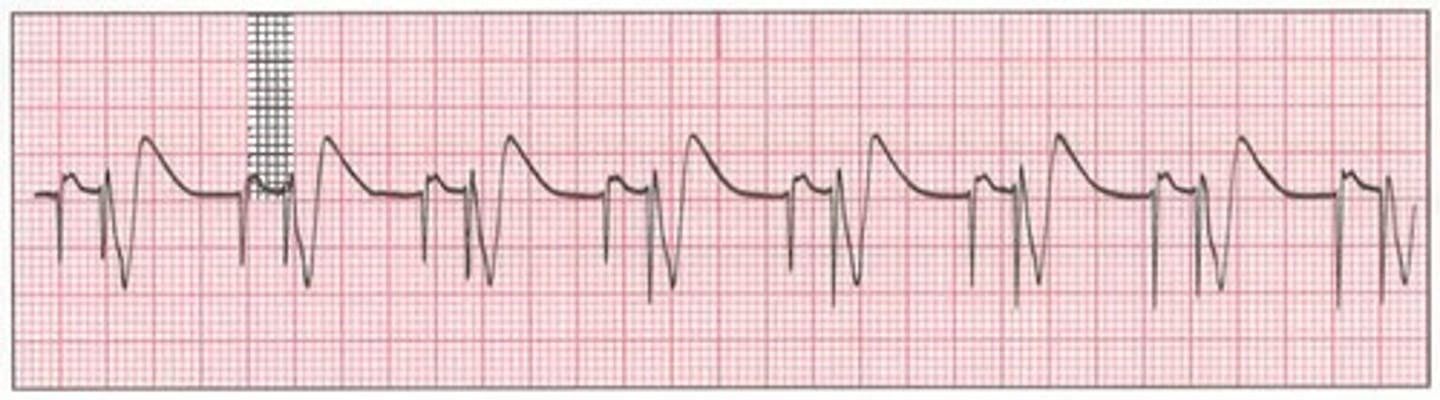 <p>Which Arrythmia is this?</p>