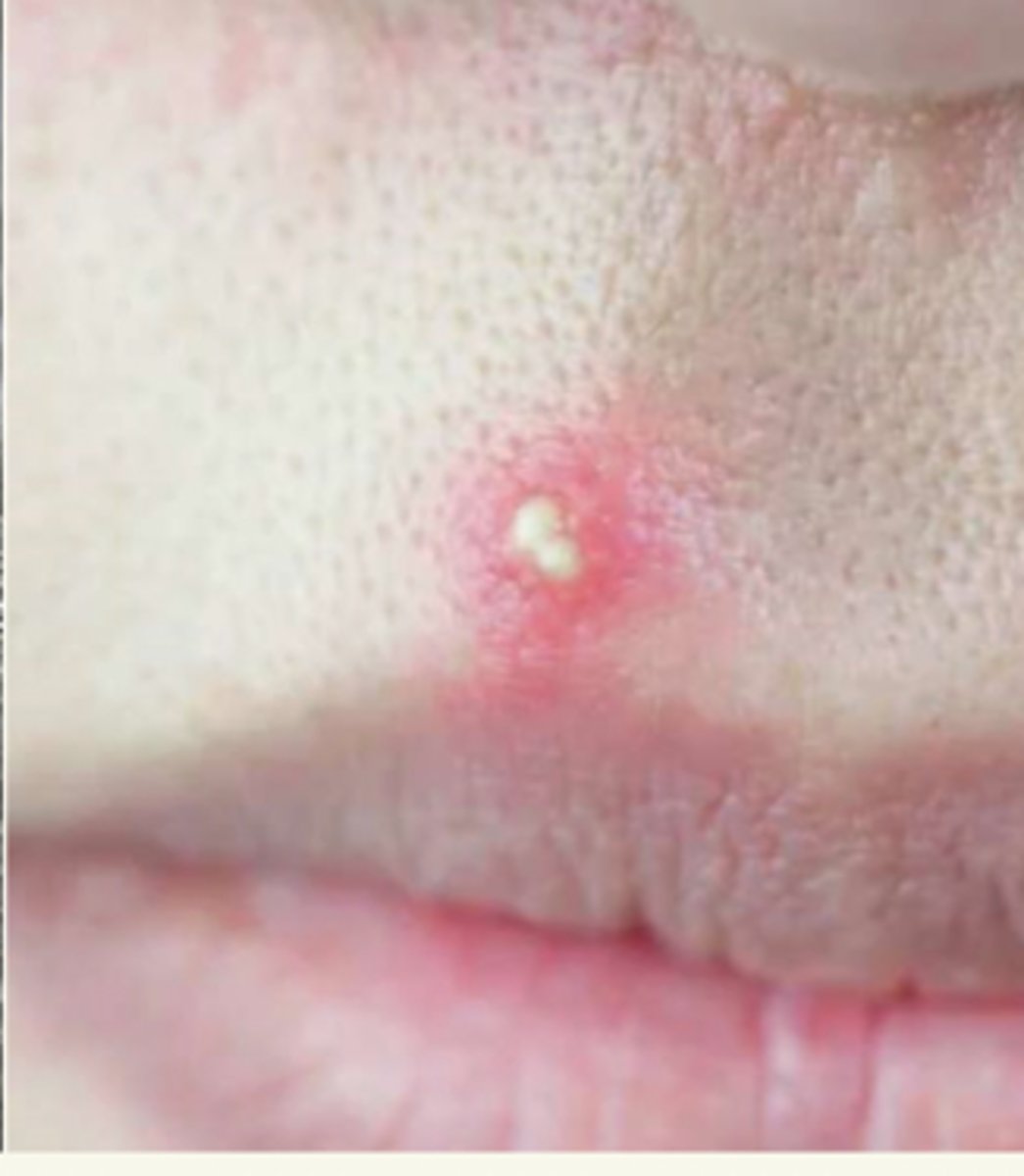 <p>¿lesión?</p><p>¿primaria o secundaria?</p>