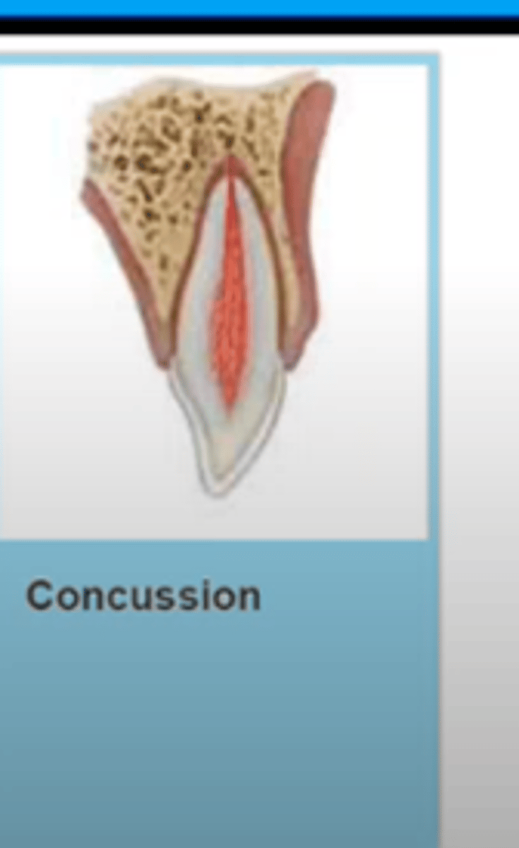 <p>injury to tooth-supporting structures without loosening or displacement, but with a marked reaction to percussion</p>