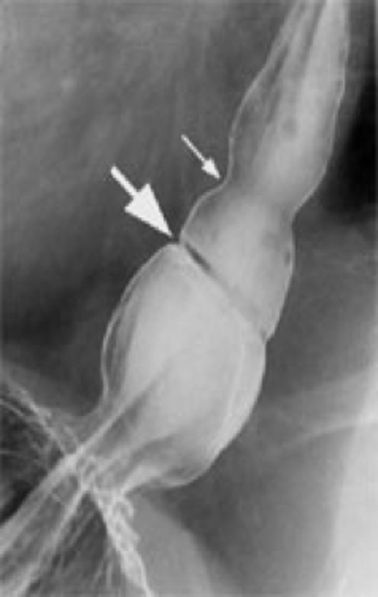 <p>Schatzki's ring (esophageal rings)</p>
