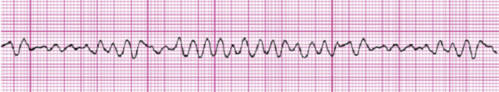 <p>Identify the rhythm! Discuss nursing and collaborative care</p>