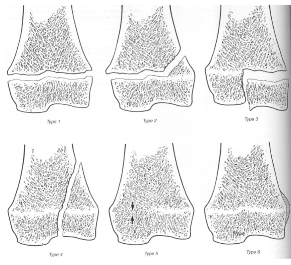 <p>Type 1: Complete separation of the physis </p><p>Type 2: Physeal Fx breaks out in metaphysis </p><p>Type 3: Intra-articular Fx, through epiphysis and physis</p><p>Type 4: Intra-articular Fx through epiphysis, physis, and metaphysis  </p><p>Type 5: Crushing injury leading to closure of physis in limited area </p><p>Type 6: Periosteal bridge between metaphysis and epiphysis slows growth on affected side  </p>