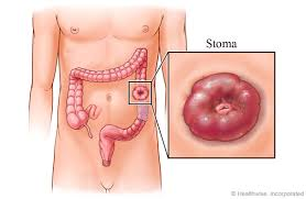 <p>an artificial opening into the colon for elimination purposes </p><p>May be <em>temporary or permanent </em></p>