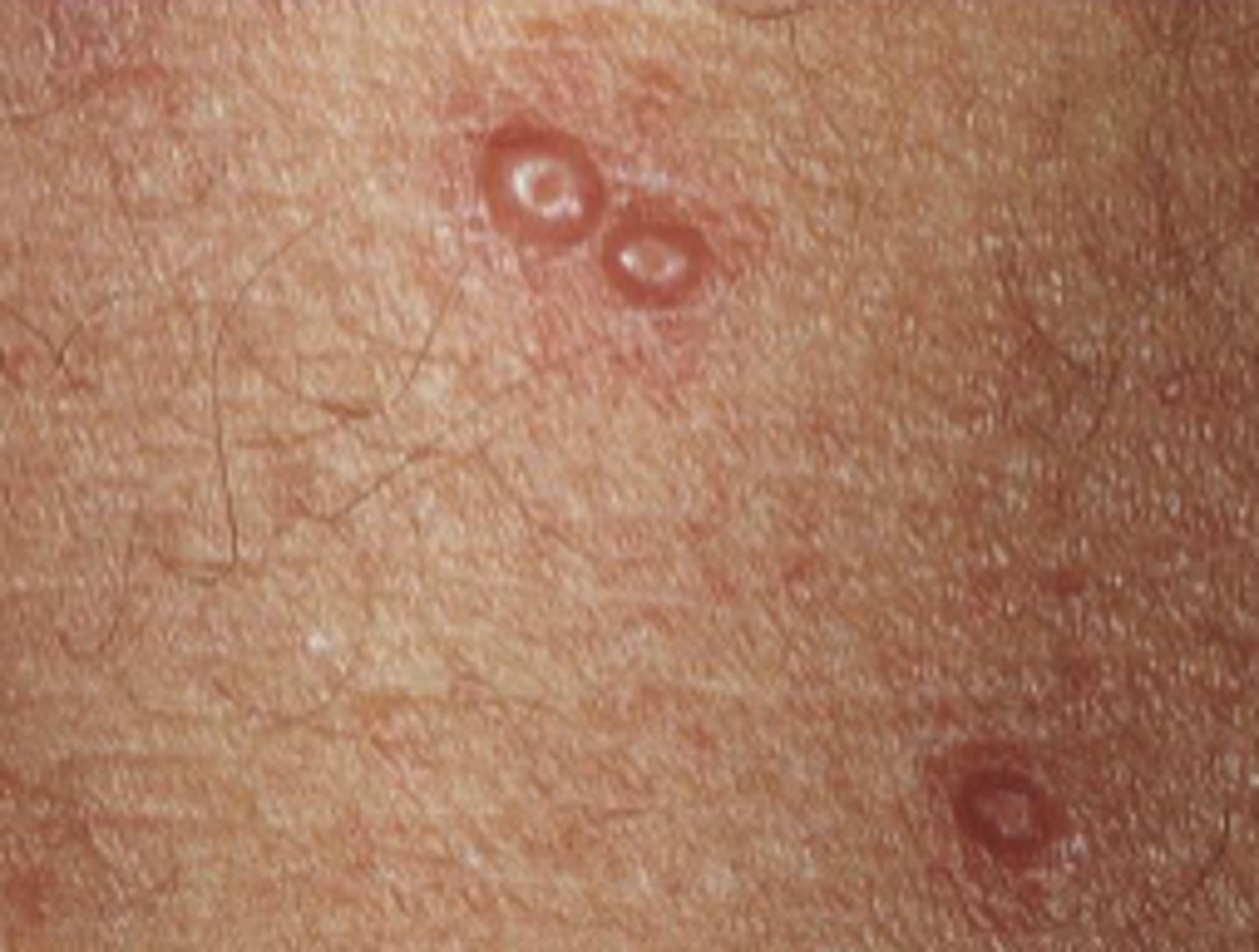 <p>slightly elevated induration of skin, <1 cm</p>