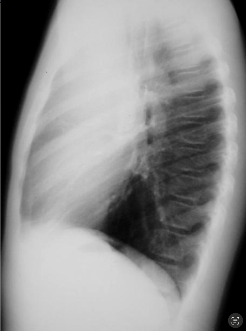 <p>Description: well-defined mass in the anterior mediastinum</p><p>Radiographic features: obliterates the retrosternal clear space, may show calcification</p>