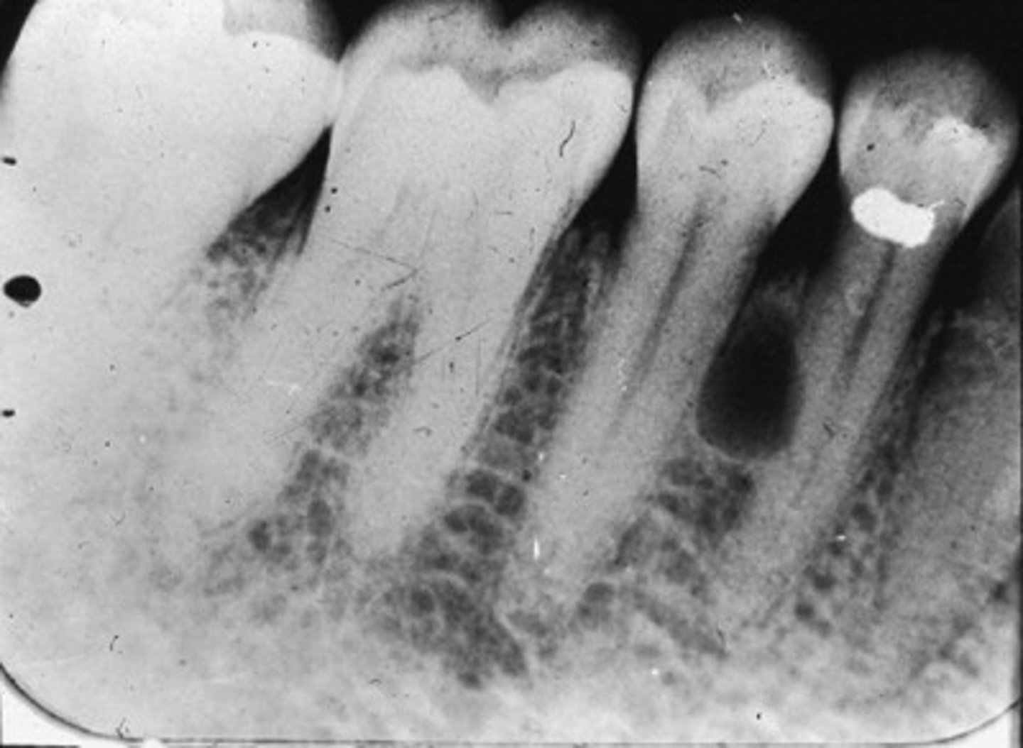 <p>Between teeth, lateral to tooth root</p>