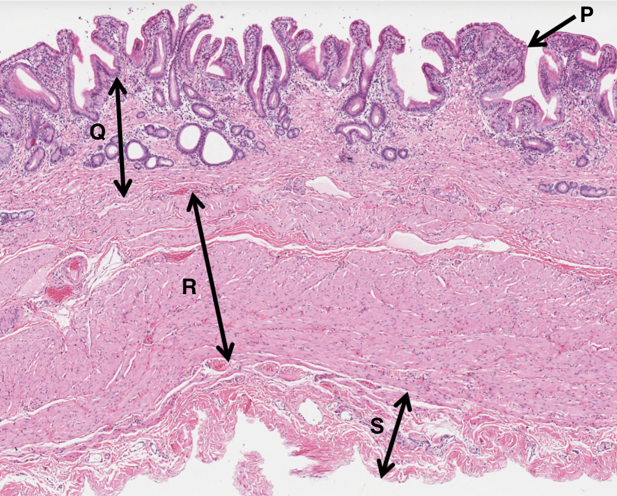<p>What is S from a gall bladder slide?</p>