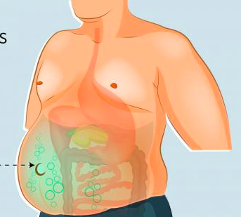 <p>Acumulación anormal de líquido libre en la cavidad peritoneal; puede corresponder a un trasudado (si no es inflamatorio), o a un exudado (si es inflamatorio). Se llama hemoperitoneo si se acumula sangre; biliperitoneo si corresponde a bilis y ascitis quilosa si se acumula linfa.</p>