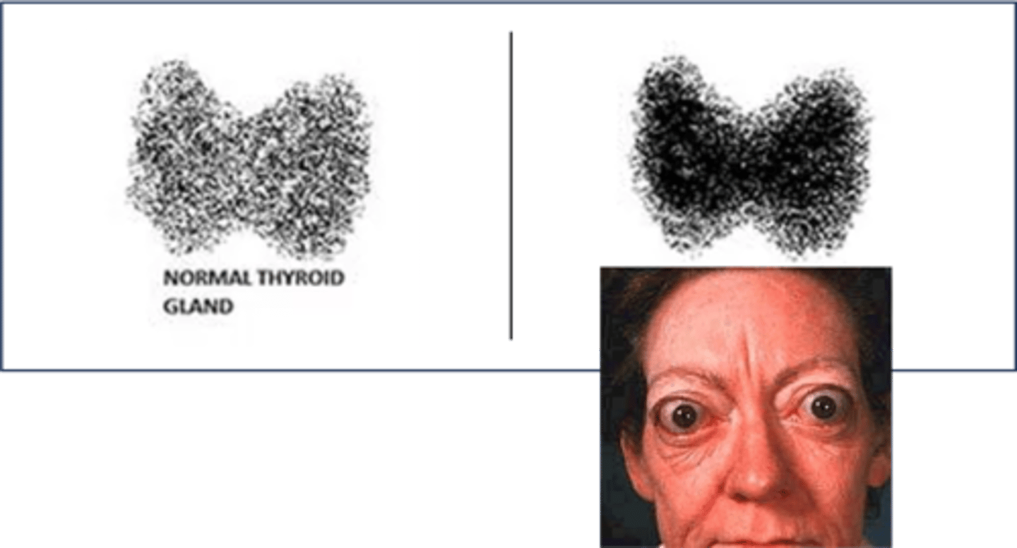 <p>Define Cause of Hyperthyroidism:</p><p>Autoimmune condition where AutoAbs bind to and stimulate TSH receptor</p><p>-Hx:</p><p>&gt; MCC of Hyperthyroidism</p><p>&gt; MC in WOMEN (usually from 20-50 y/o, but can occur in childhood to adolescence)</p><p>-Path:</p><p>-Sx:</p><p>&gt; Tremors</p><p>&gt; Palpitations</p><p>&gt; Anxiety</p><p>&gt; Diarrhea</p><p>&gt; Heat Intolerance</p><p>&gt; Wt Loss</p><p>&gt; Fatigue</p><p>-PE:</p><p>&gt; Tachycardia</p><p>&gt; Systolic HTN w/ widened pulse pressure</p><p>&gt;&gt; High SBP d/t increased cardiac output</p><p>&gt;&gt; Low DBP d/t less PVR</p><p>&gt; Wt Loss</p><p>&gt; Eyelid Lag (abnormally raised upper eyelid d/t SNS hyperactivity --&gt; still see sclera when they look down)</p><p>&gt; ENLARGED THYROID GLAND (Stimulation of TSH receptor)</p><p>&gt; Exophthalmos (Proptosis)</p><p>-Dx:</p><p>Labs</p><p>&gt; TSH receptor Ab (TRAb) = POSITIVE</p><p>&gt; TSH = Low</p><p>&gt; Free T4 = High (Total T3 = HIGH - rises before Free T4)</p><p>Radioactive Iodine Uptake Scan</p><p>&gt; High = LOTS of new TH</p><p>-Tx: ALL 1st Line</p><p>&gt; Thionamides = Methimazole, PTU (Antithyroid)</p><p>&gt; Thyroidectomy --&gt; Life time Levothyroxine</p><p>&gt; Radioactive Iodine Ablation --&gt; Life time Levothyroxine</p><p>&gt; Beta Blocker (Sx relief when TH High)</p>
