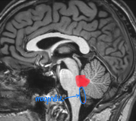 <p>between brainstem and cerebellum</p><p>CSF leaves via 3 exit foramina (1 magendie near midline and 2 luschka on lateral sides)</p>