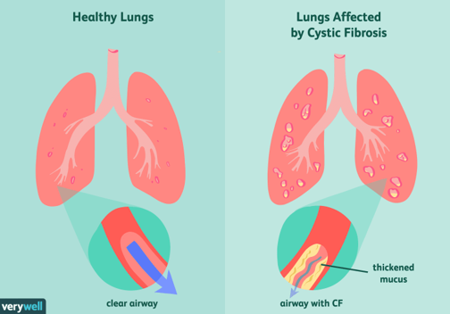 <p>Cystic fibrosis</p>