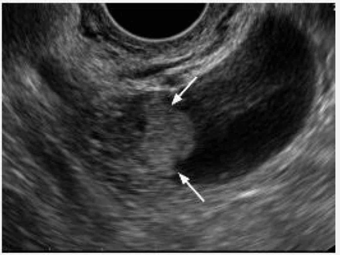 <p>invasive tumor</p><p>Age: 50-60 yo</p>
