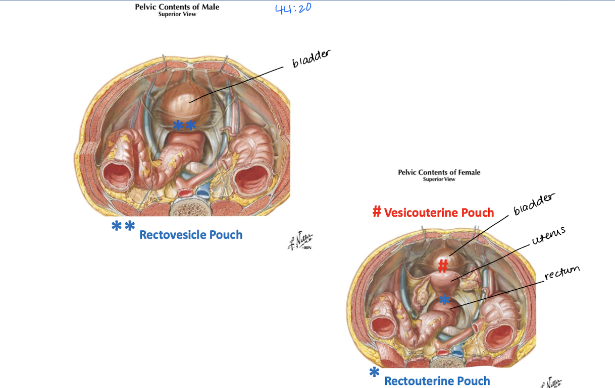<p>Male</p><ul><li><p>Rectovesical pouch</p></li></ul><p>Female</p><ul><li><p>Vesicouterine pouch</p></li><li><p>Rectouterine pouch</p></li></ul><p></p>