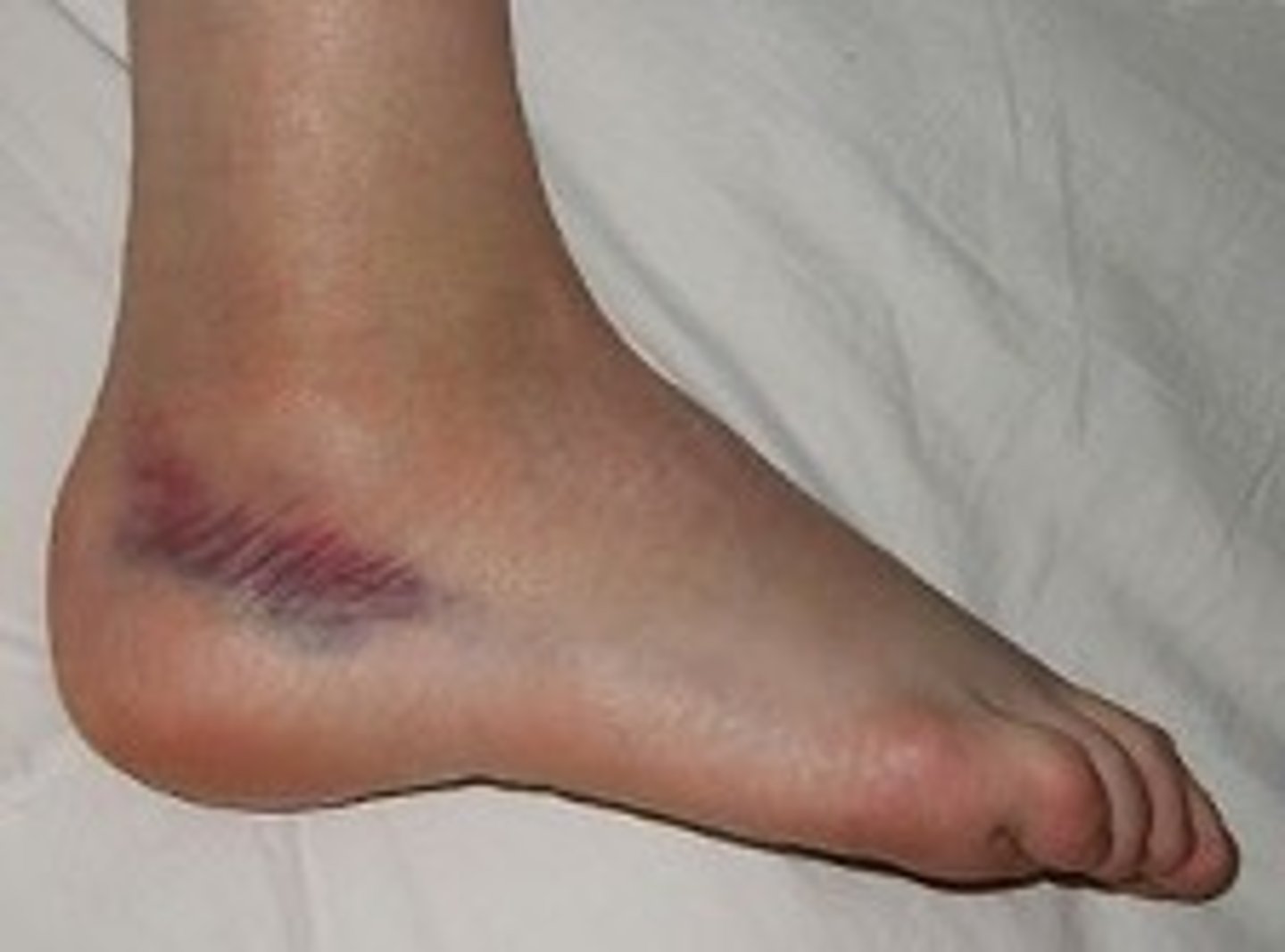 <p>Forced wrenching or twisting of a joint, resulting in partial rupture or tearing of supporting ligaments</p>
