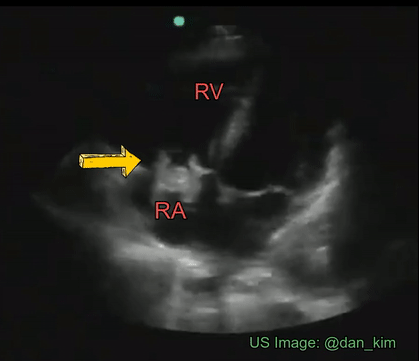<p><span><span>Identify the cardiac pathology demonstrated in the image.</span></span></p><p>Right atrial myxoma</p><p>Mitral stenosis</p><p>Tricuspid endocarditis/vegetation</p><p>Tricuspid stenosis</p>