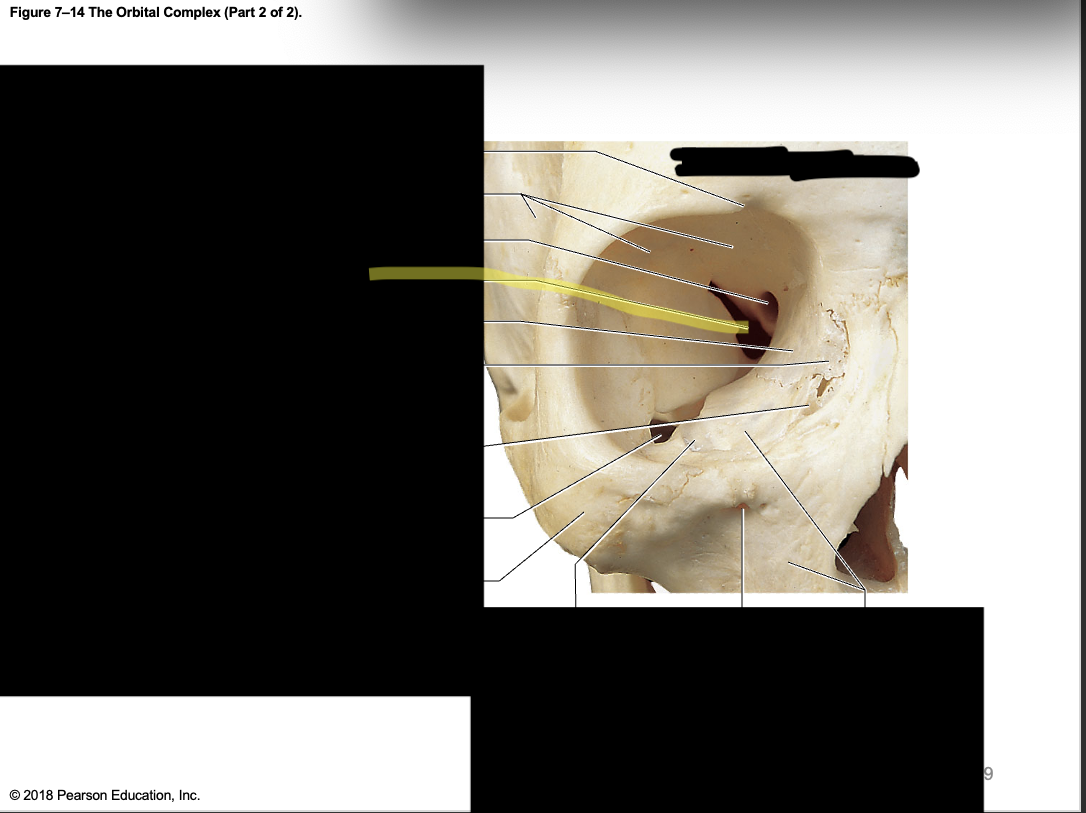 <p>Superior orbital fissure </p>
