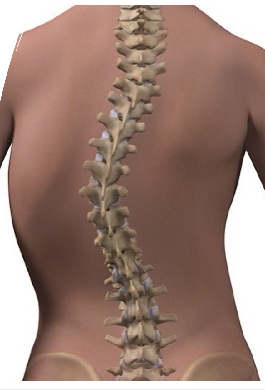 <p>A sideways curvature of the spine that often occurs during growth spurts before puberty.</p>
