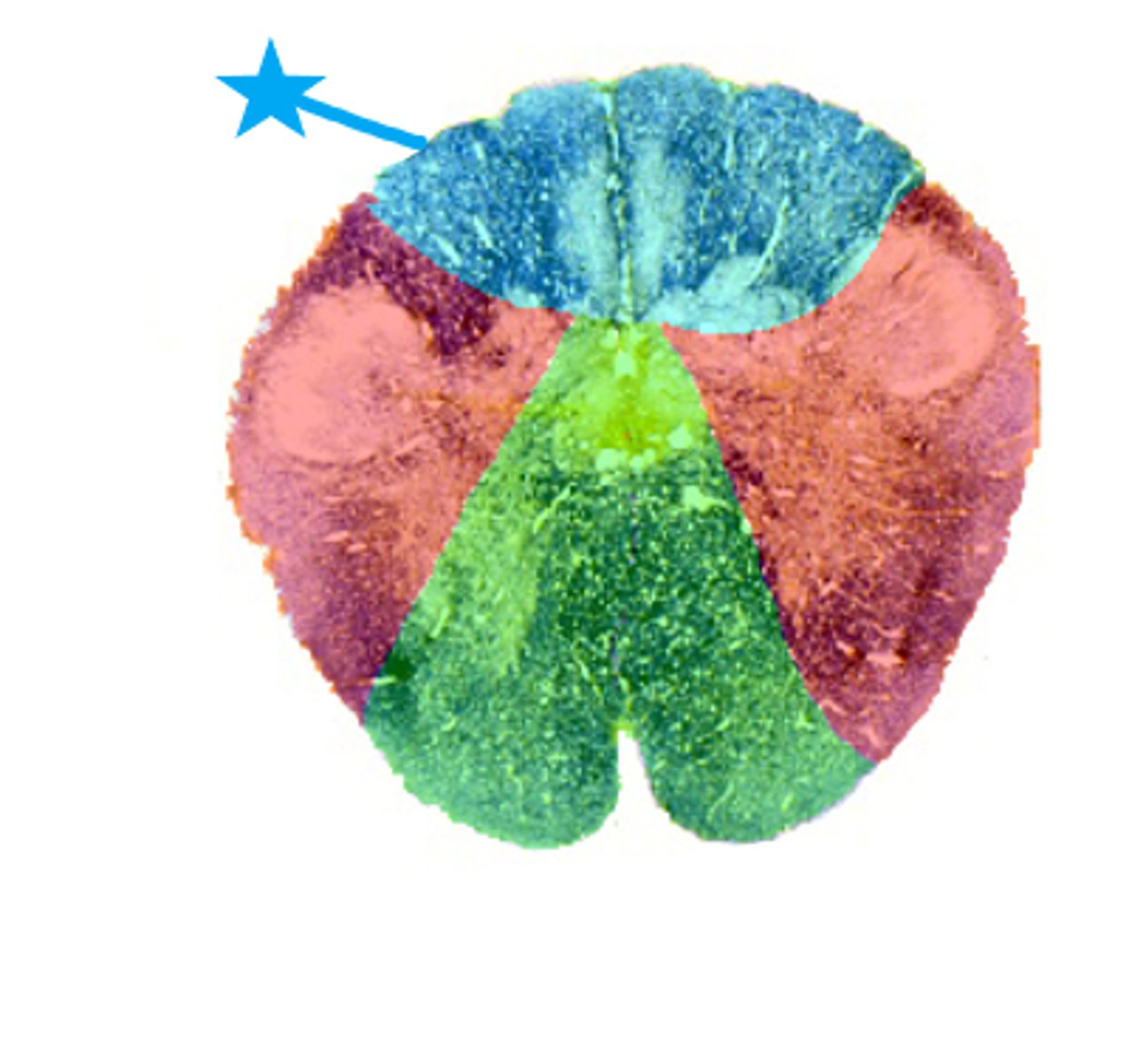 <p>The dorsal columns of the spinal cord is primarily served by what blood vessel labeled with the blue star seen here?</p><p>A. Posterior Spinal Artery</p><p>B. Posterior Cerebral Artery</p><p>C. Anterior Spinal Artery</p><p>D. Vertebral Artery</p><p>3 multiple choice options</p>