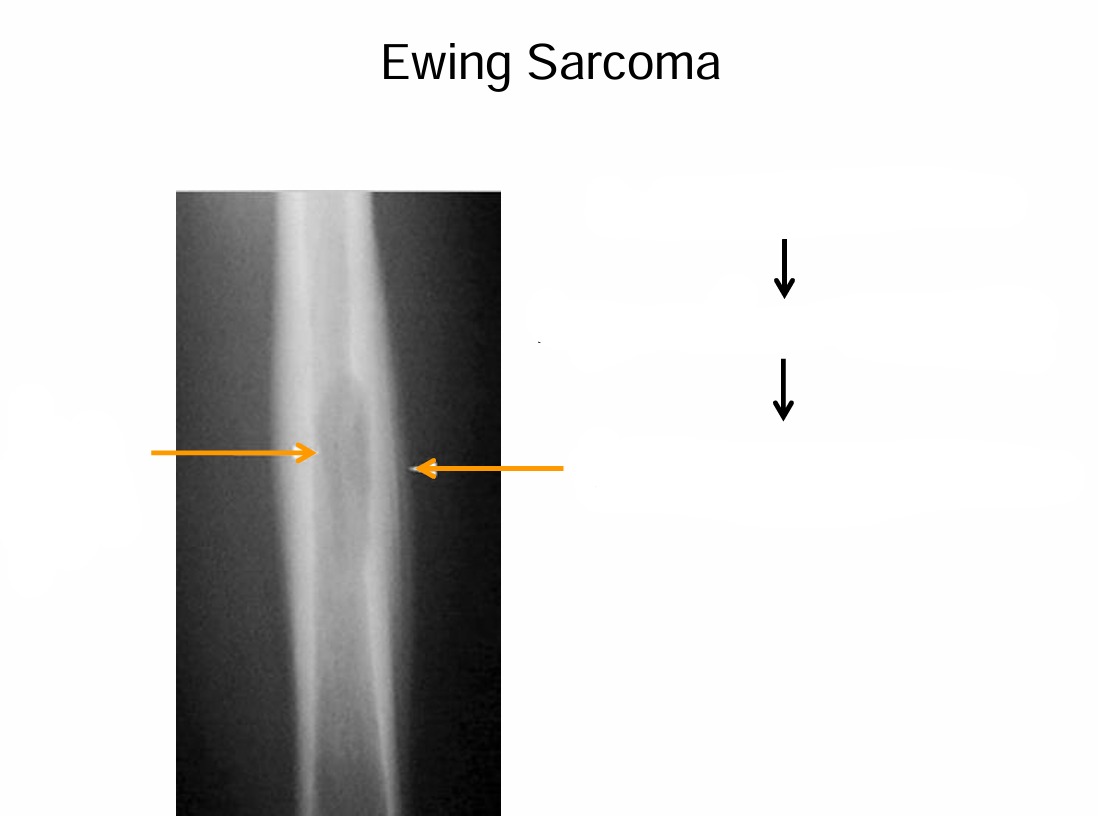 <p>Ewing Sarcoma Radiology</p>