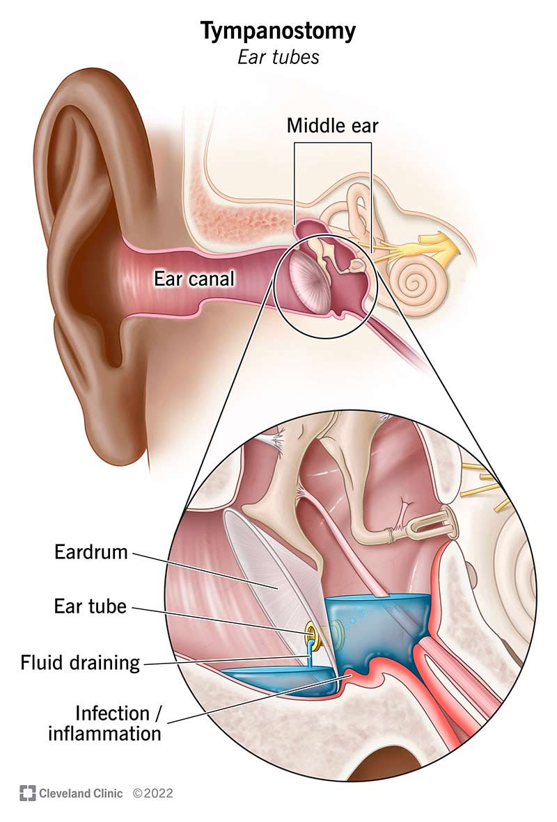 <p>A surgical procedure that involves making an incision in the eardrum to relieve pressure and drain fluid from the middle ear.</p><p></p>