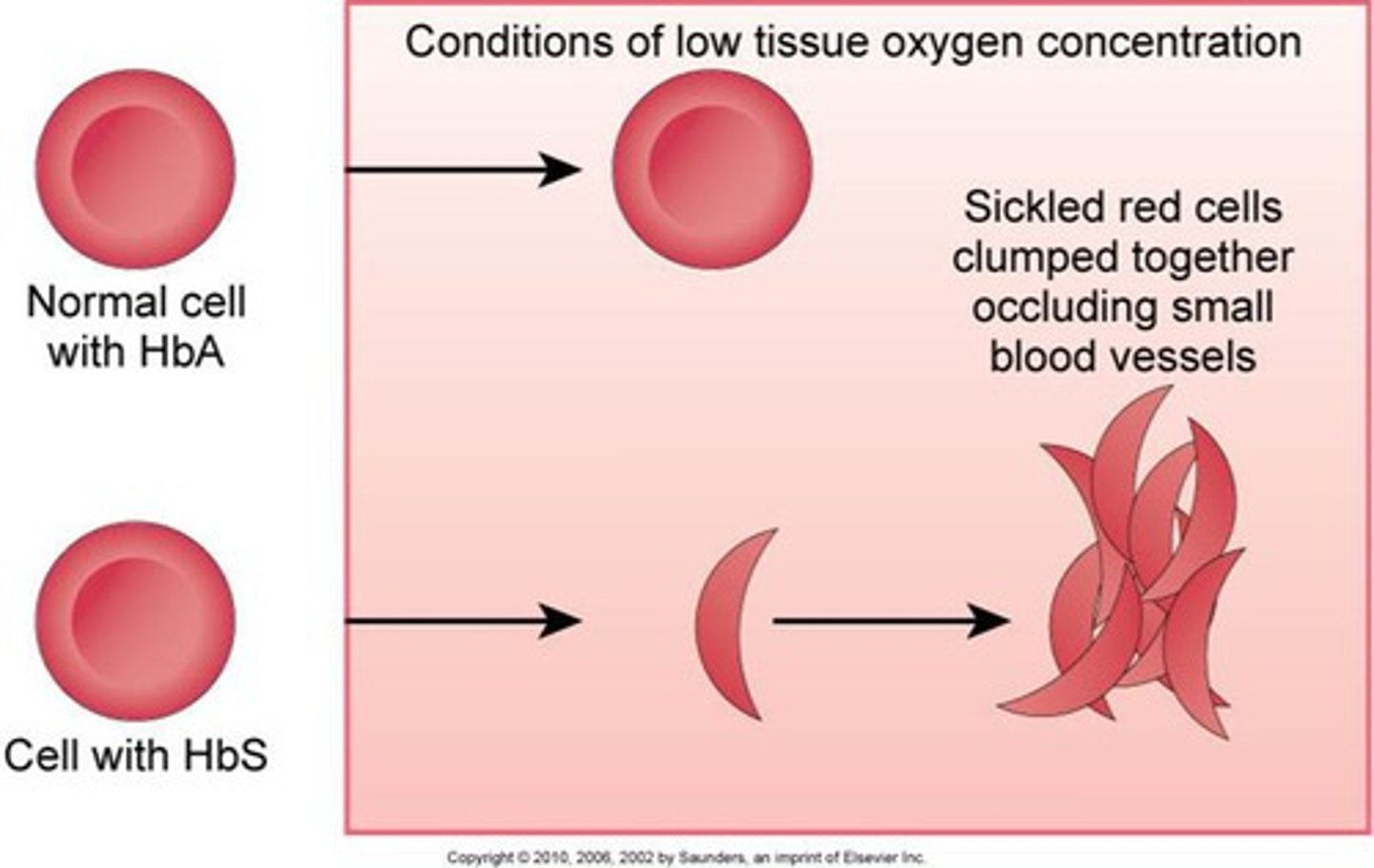 <p>partial or complete replacement of normal hemoglobin with abnormal hemoglobin S (Hgb S)</p><p>hemoglobin in the RBCs takes on an elongated "sickle" shape</p><p>sickled cells are rigid and obstruct capillary blood flow</p><p>microscopic obstructions lead to engorgement and tissue ischemia</p><p>hypoxia occurs and causes sickling, leading to pain (can be exercise induced)</p><p>large tissue infections occur</p><p>damaged tissues in organs; impaired function</p><p>-splenic sequestration (holds extra RBCs, take on abnormal RBCs so it gets filled and enlarged, risk of rupture) may require splenectomy at an early age</p>