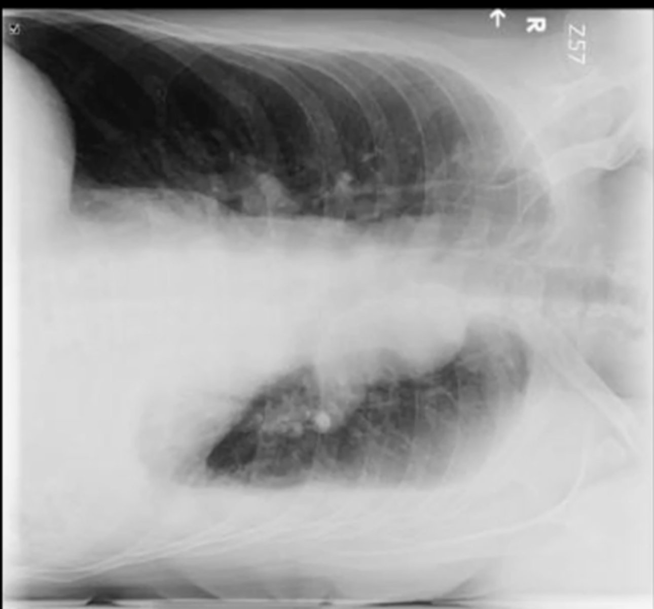 <p>left lateral decubitus xray</p>