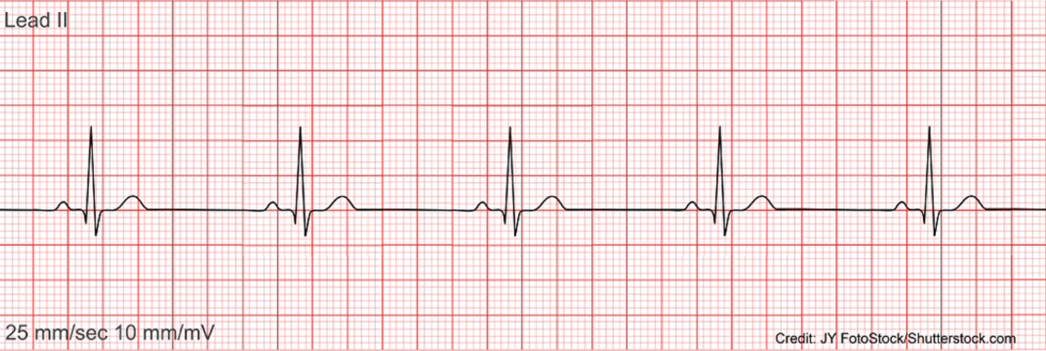 <p>What does this EKG represent?</p>