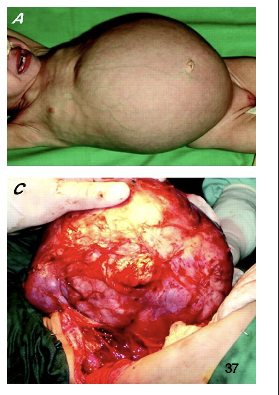 <ul><li><p>most common kidney tumor of childhood (ages 2-5)</p></li><li><p>90% are sporadic, less than 10% associated with WT1 or WT2 mutations</p></li><li><p><em>Presents as large abdominal mass</em></p></li><li><p>responsive to surgery and chemotherapy, 90+% cure rate</p></li><li><p>increases risk of developing other cancers (leukemia)</p></li></ul><p></p>