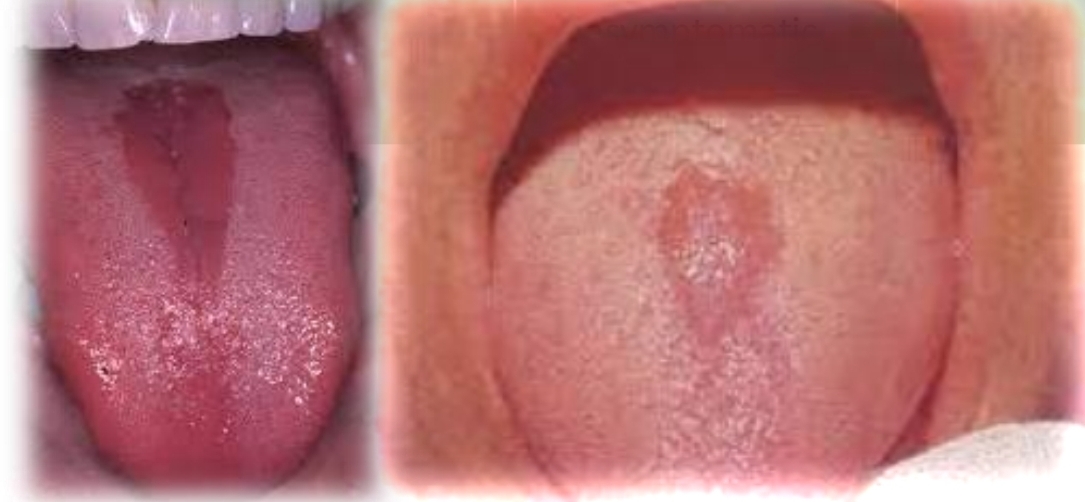<p>Localized red depapilated patch on midline of posterior dorsal tongue. Oval to rhomboid shape, smooth or lobulated durface. May be seen with kissing lesion</p><p class="has-focus">Asymptomatic</p><p class="has-focus">First and second decades</p><p class="has-focus">No gender bias</p>