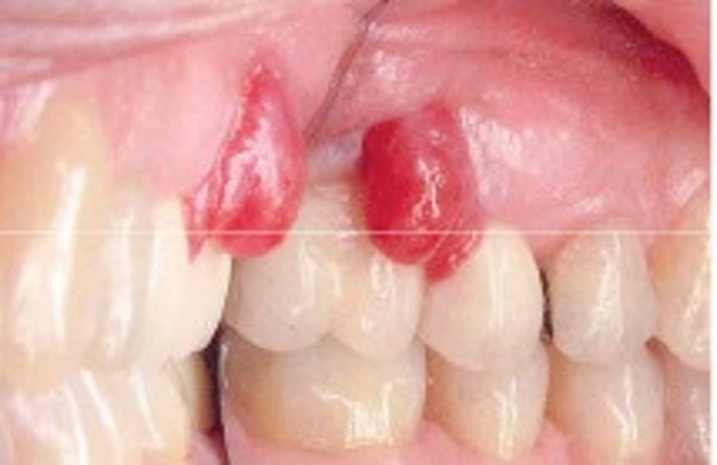 <p>Small, reddish bumps on the skin that bleed easily due to an abnormally high number of blood vessels. It is a primarily oral disease which appears as an overgrowth of tissue due to irritation, physical trauma or hormonal factors. It is not an infectious but a reactive lesion due to local irritating factors.</p>