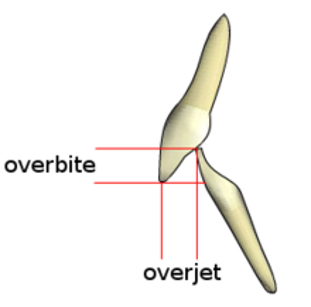 <p>vertical overlap between the two arches</p>