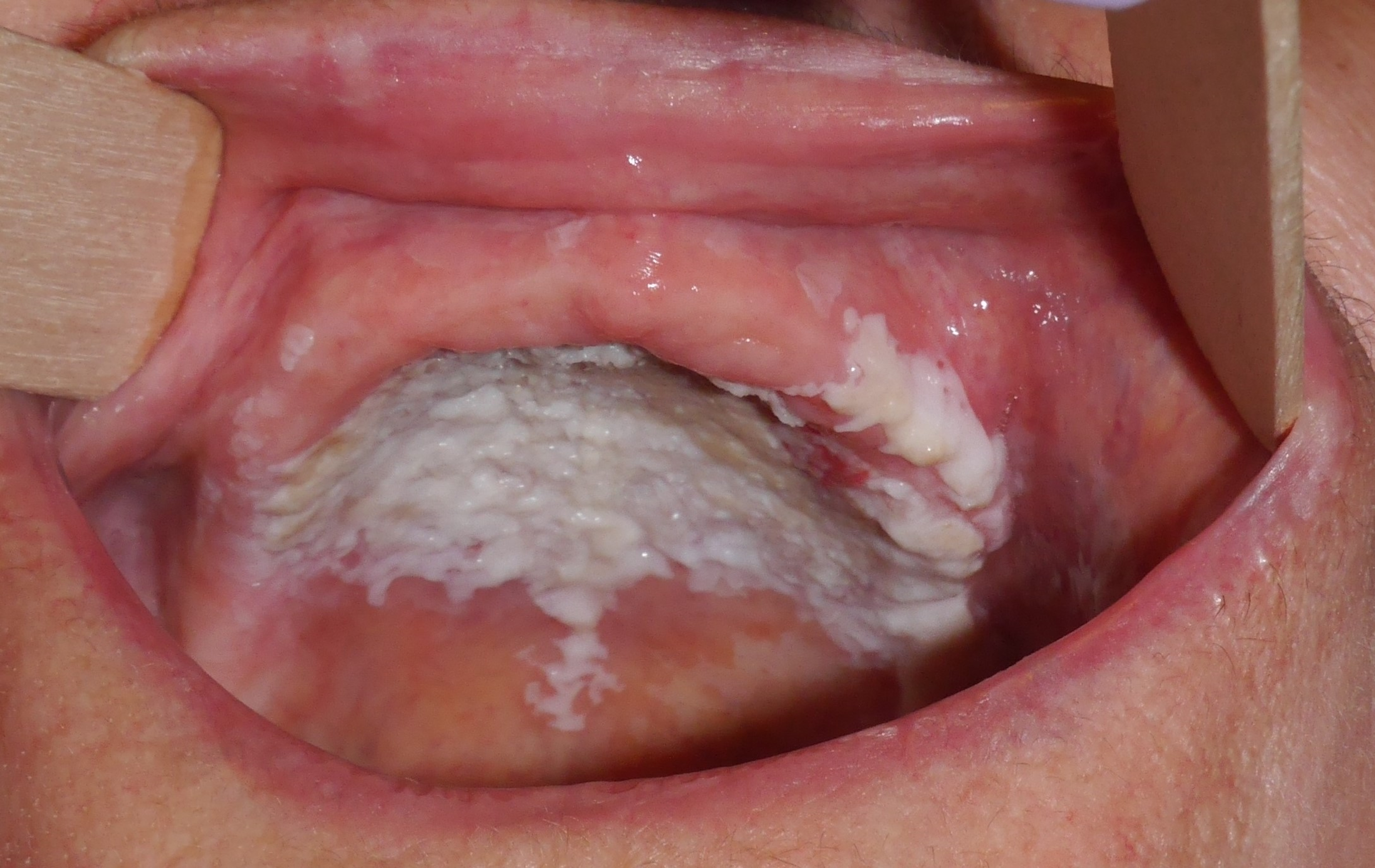 <p>Leukoplakia</p>