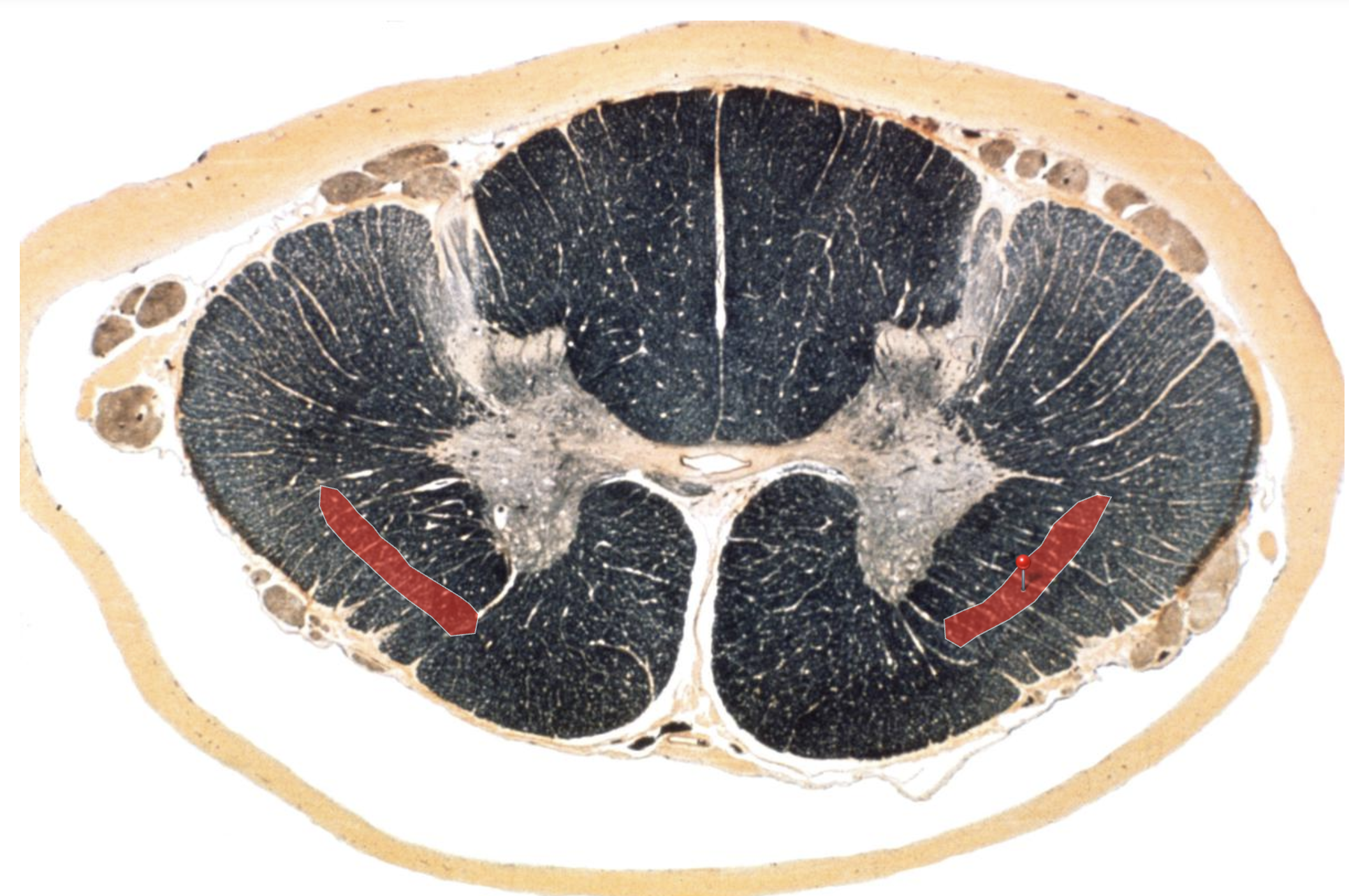 <p>Spinothalamic Tract —&gt; P&amp;T</p>