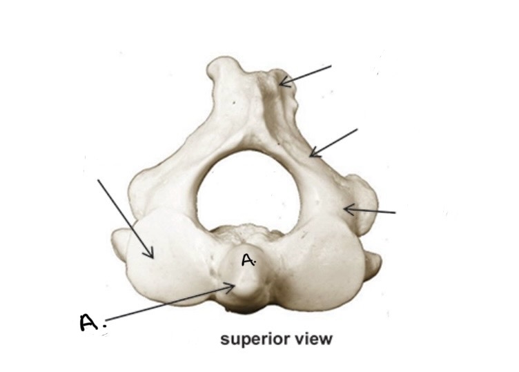 <p>What Vertebra bone is this?</p><p>What is A?</p>
