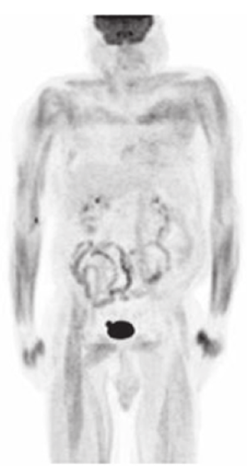<p>This FDG PET scan demonstrates: </p>