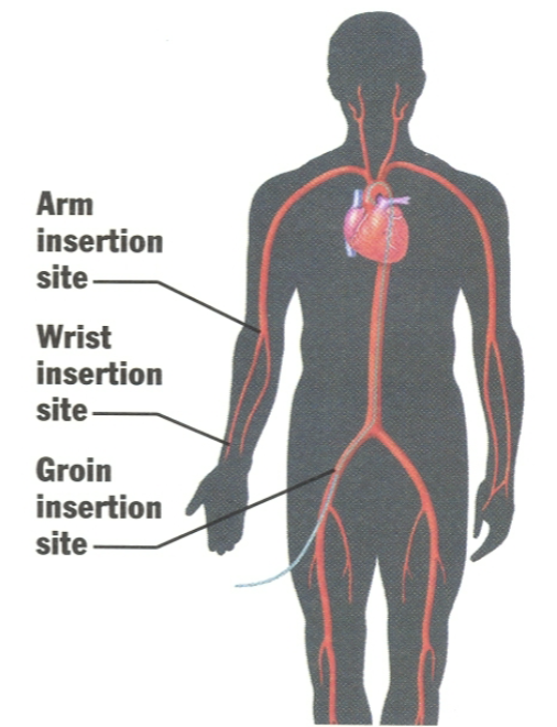 <ul><li><p>Femoral</p></li><li><p>Subclavian</p></li><li><p><strong>Brachial</strong> (<u>more vasc complications</u> associated)</p></li><li><p><strong>Radial</strong> → becoming more and more popular</p></li><li><p>Arm, Wrist, and/or Groin</p></li></ul><p></p>