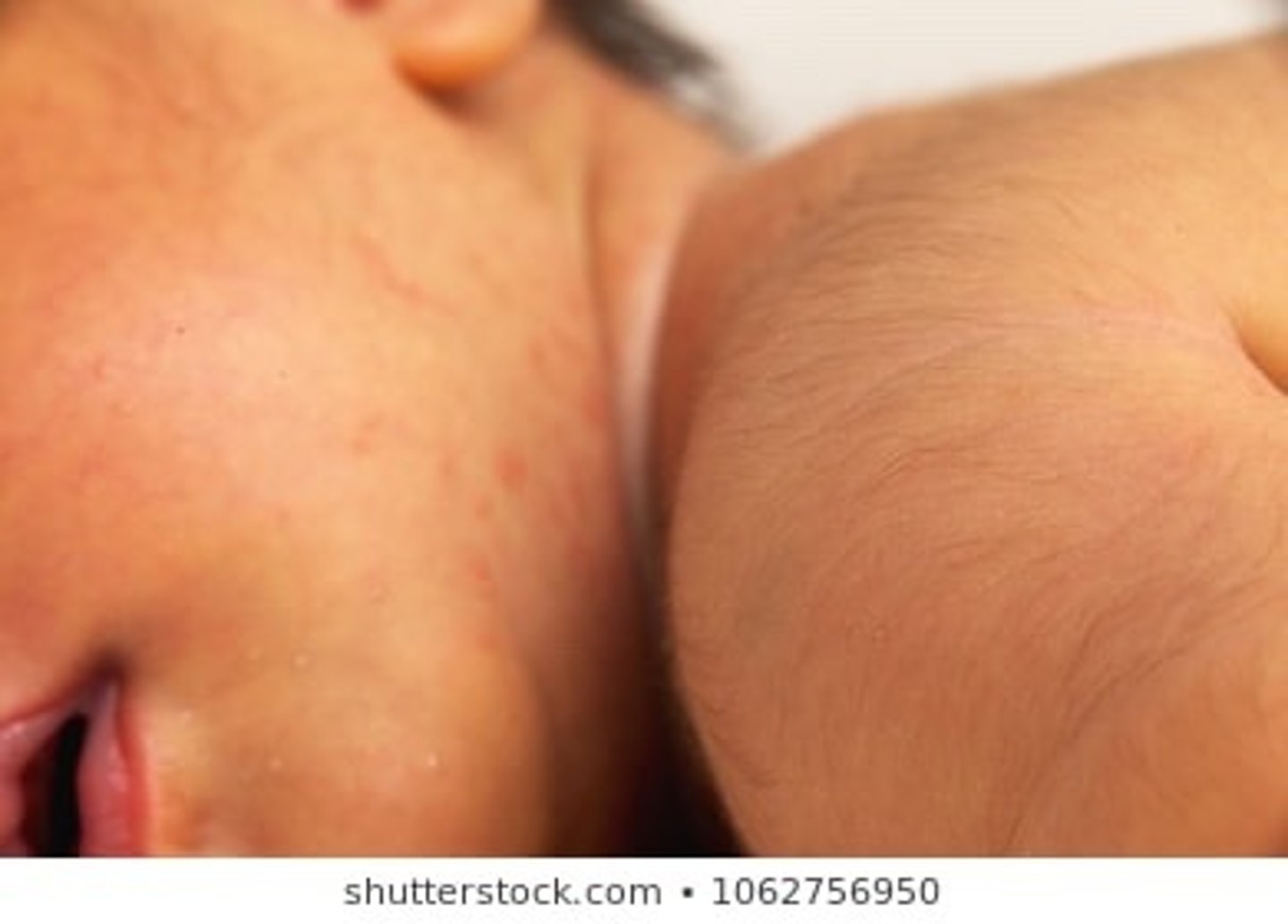 <p>Fine hairs found on body of fetus</p>