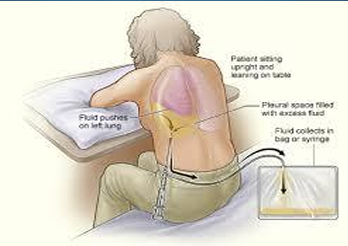 <p> ● Prepare patient for procedure providing reassurance regarding pain (Because patients are </p><p>awake for the procedure, they often have a great sense of fear about pain)</p><p> ● Ensure proper positioning.</p><p> ● Monitor vital signs before, during, and after procedure.</p><p> ● Ensure MD has appropriate space for maintaining aseptic technique.</p><p> ● Assess breath sounds after procedure.</p><p> ● Send specimens to lab as ordered and per hospital policy, discard per hospital policy if no </p><p>orders for lab. </p>
