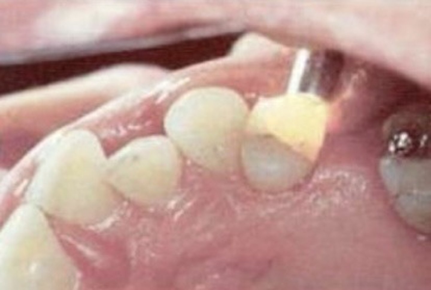 <p>How is transillumination/bite stick used for diagnostic testing?</p>