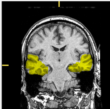 <p>What lobe of the brain is highlighted?</p>
