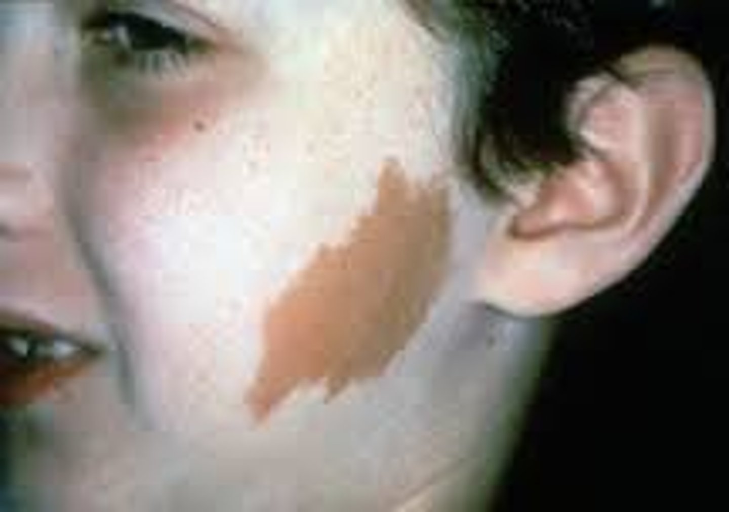 <p>Flat, nonpalpable, irregular shaped macule</p><p>Greater than or equal to 1 cm</p><p>Examples include vitiligo, port-wine stains, cafe au lait spots</p>