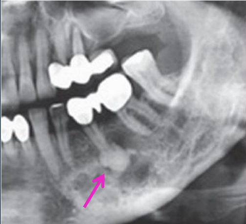 <ul><li><p>single lesion</p></li><li><p>radiolucent to radiopaque</p></li><li><p>in tooth-bearing areas of the jaw</p></li><li><p><u>well-defined rim during mixed stage</u></p></li><li><p>smaller than 1.5 cm</p></li></ul><p></p>