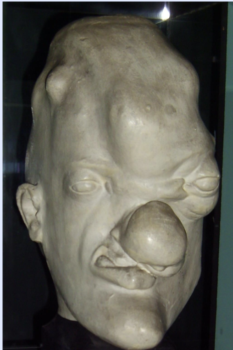 <p>nodular granulomatous lesions (soft, tumor-like masses) affecting skin/bone/live/anywhere (tertiary syphilis)</p><p>can take years to develop after infection 15-45</p>