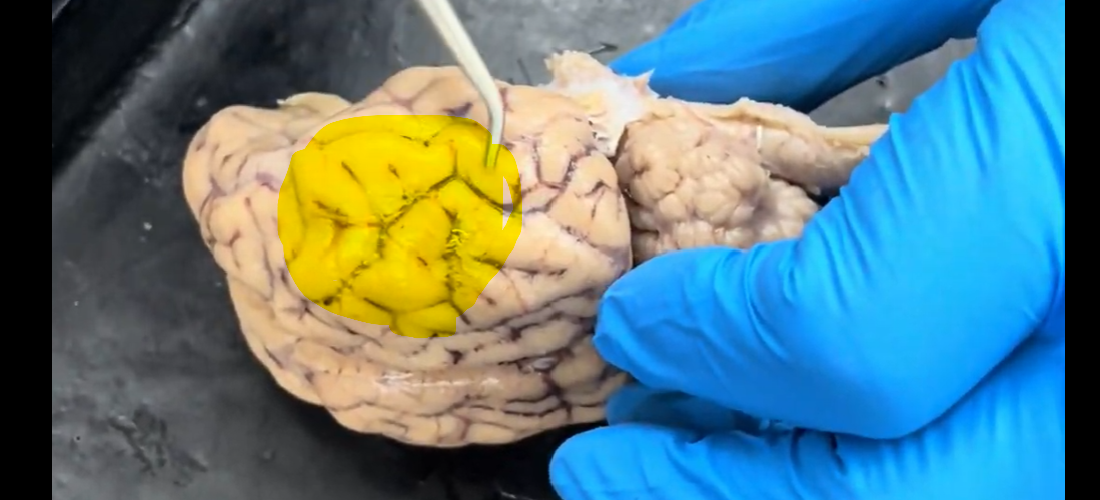 <p>Name the part of the brain at the tip of the probe and highlighted in yellow.</p>